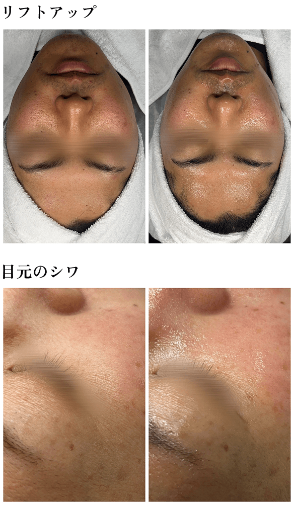 フェイシャル施術前後の顔全体の肌状態を比較した写真