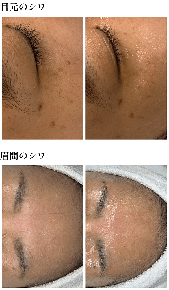 フェイシャル施術前後の頬と口元の肌状態を比較した写真